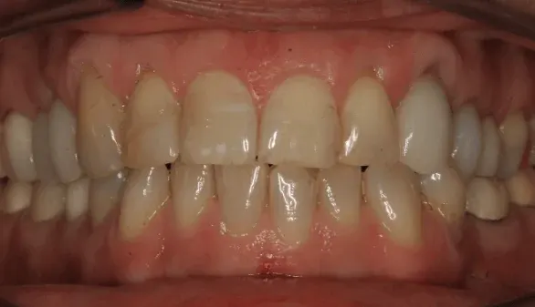 Before smile makeover at Empower Your Smile, Tribeca