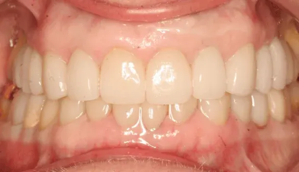 After smile makeover by Dr. Patricia Moezinia, Tribeca NYC