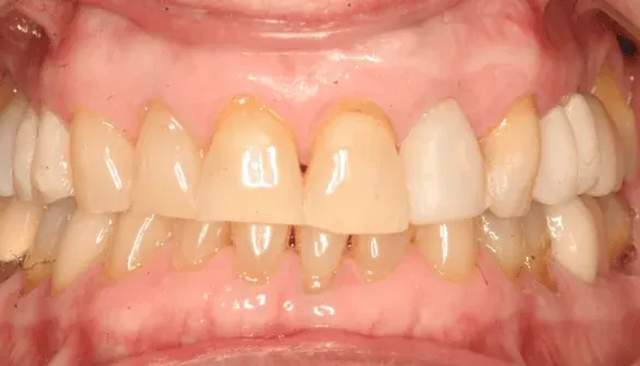 Before smile makeover at Empower Your Smile, Tribeca