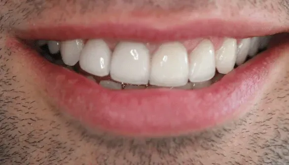 After smile makeover by Dr. Patricia Moezinia, Tribeca NYC