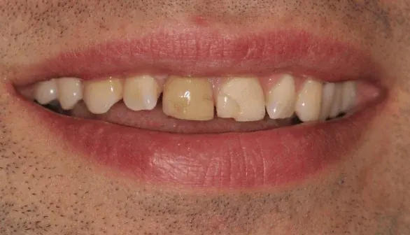 Before smile makeover at Empower Your Smile, Tribeca