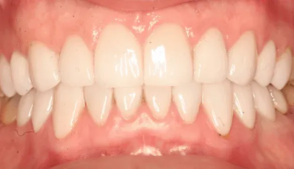 After smile makeover by Dr. Patricia Moezinia, Tribeca NYC