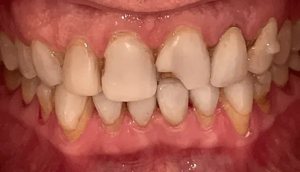 Before smile makeover at Empower Your Smile, Tribeca