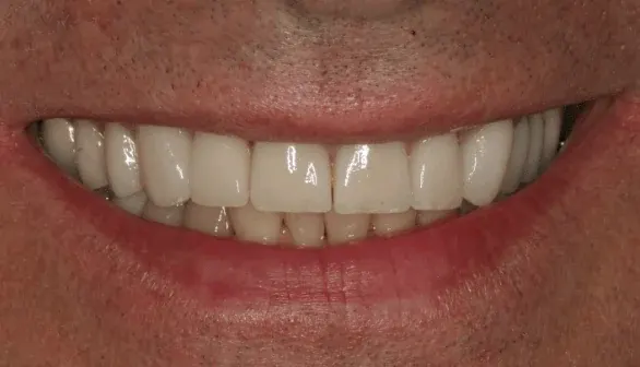 After smile makeover by Dr. Patricia Moezinia, Tribeca NYC