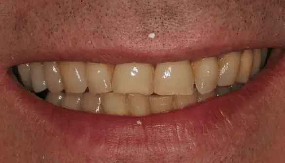 Before smile makeover at Empower Your Smile, Tribeca