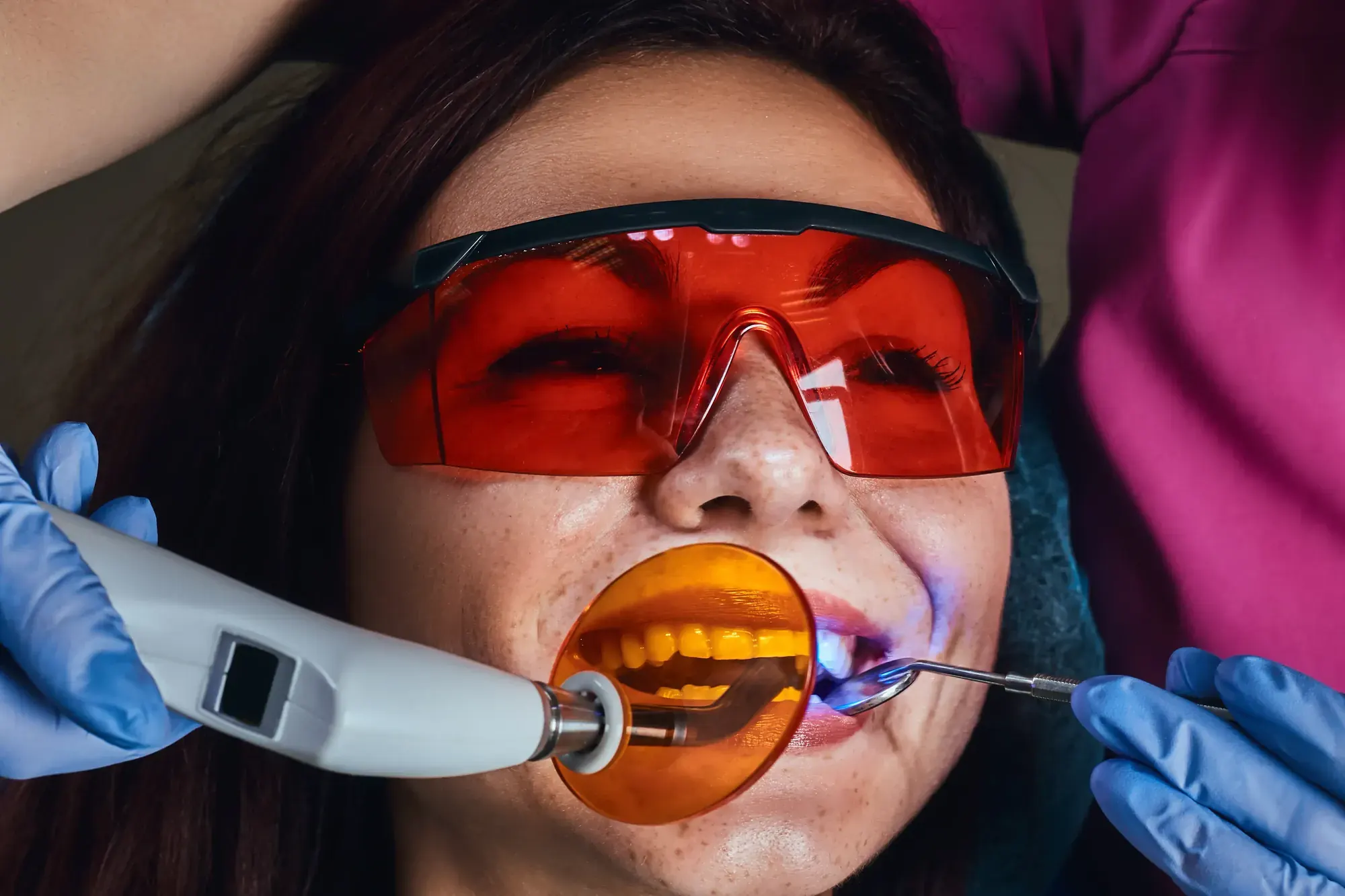 Patient in orange safety glasses as a curing light sets cosmetic bonding on a chipped tooth in Tribeca