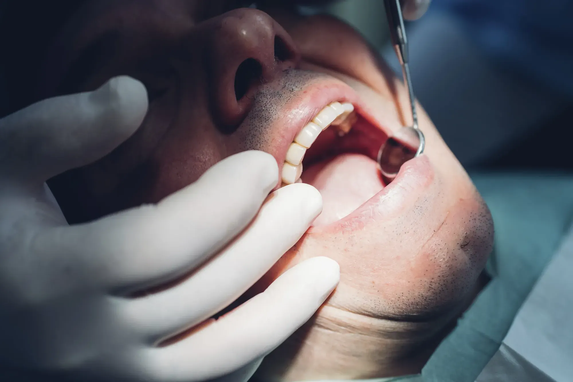 Gloved hands examining a patient’s gum tissue up close before a gingivectomy or frenectomy