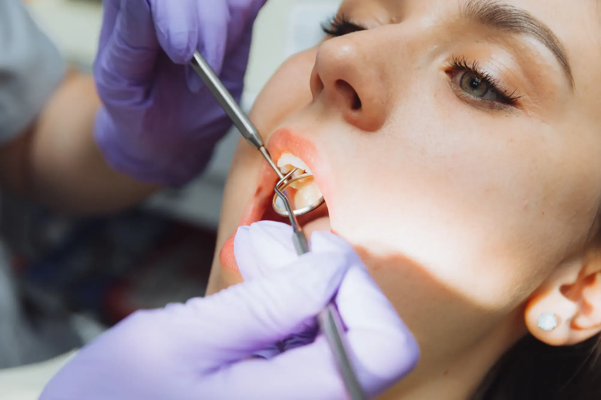 Close-up of a dental exam with a mirror and probe, the first step of scaling and root planing for gum health