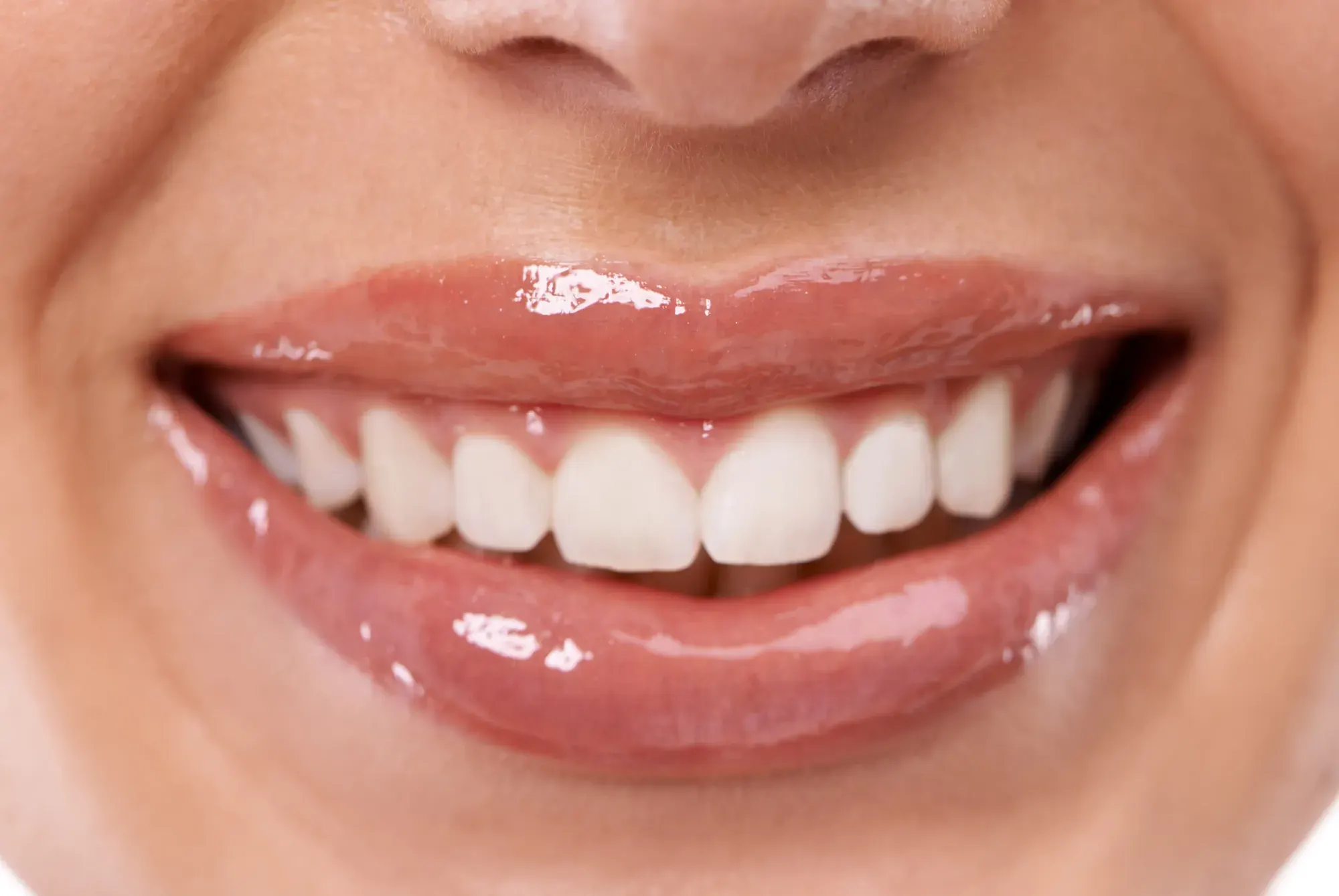 Close-up of a smile with glossy lips and well-proportioned teeth and gums, the result of gum contouring or crown lengthening